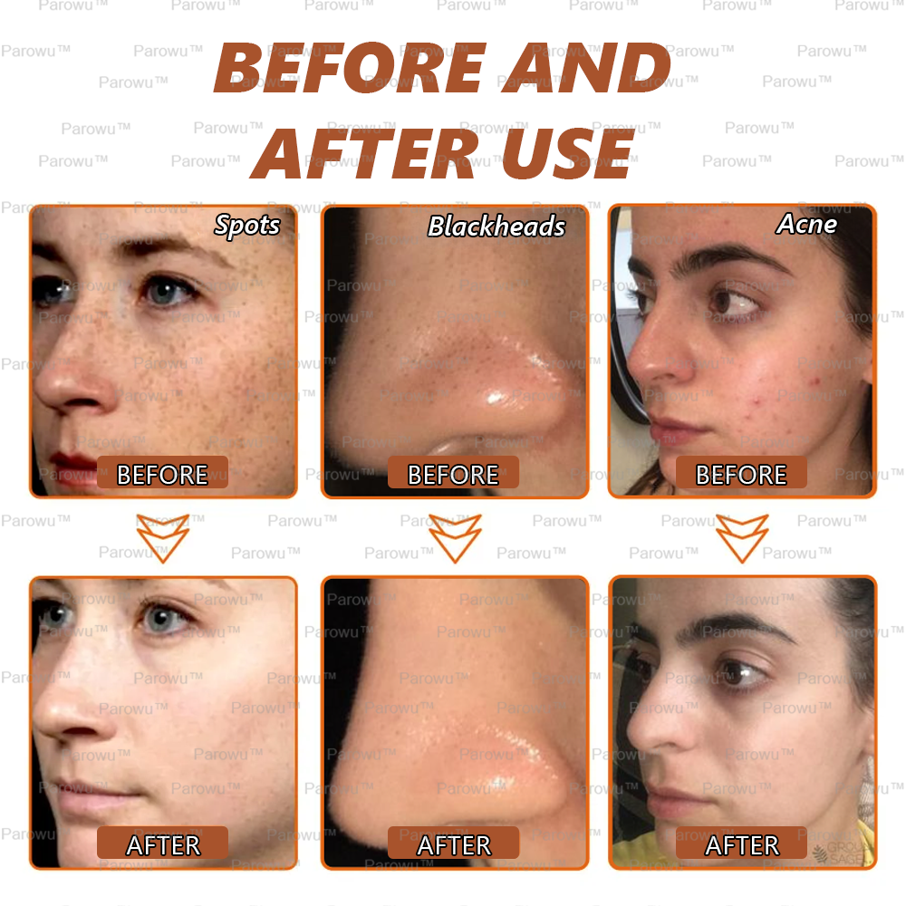 🏵️🏵️ Parowu™ Whitening and Spot-Removing Face Mask Suitable for face and body – 👩⚕️ Natural ingredients permanently remove age spots, freckles, sun spots, and liver spots.