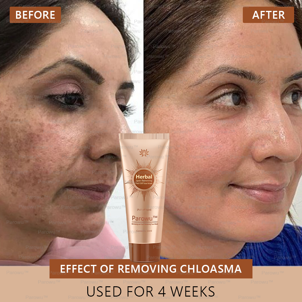 🏵️🏵️ Parowu™ Whitening and Spot-Removing Face Mask Suitable for face and body – 👩⚕️ Natural ingredients permanently remove age spots, freckles, sun spots, and liver spots.