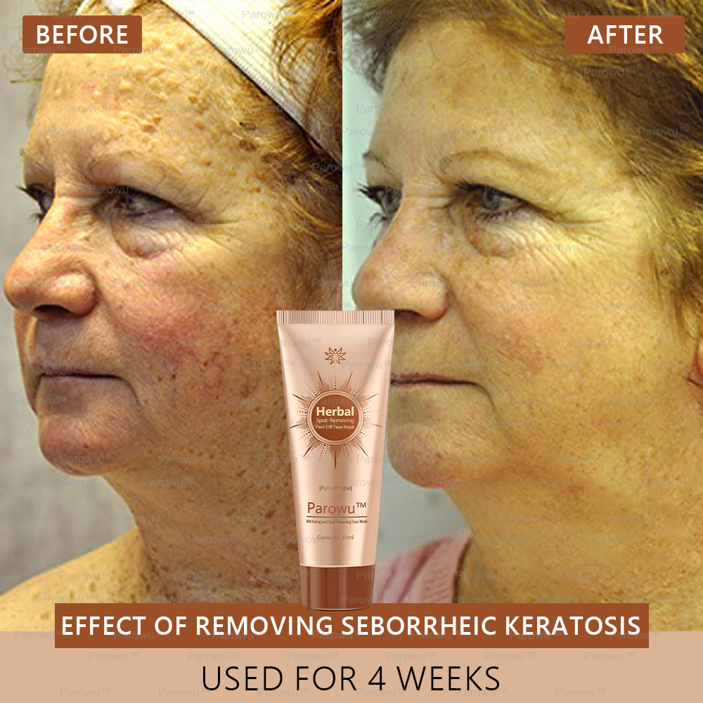 🏵️🏵️ Parowu™ Whitening and Spot-Removing Face Mask Suitable for face and body – 👩⚕️ Natural ingredients permanently remove age spots, freckles, sun spots, and liver spots.
