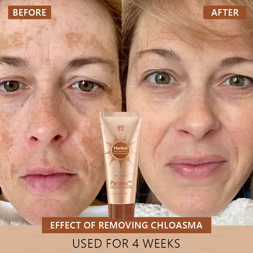 🏵️🏵️ Parowu™ Whitening and Spot-Removing Face Mask Suitable for face and body – 👩⚕️ Natural ingredients permanently remove age spots, freckles, sun spots, and liver spots.